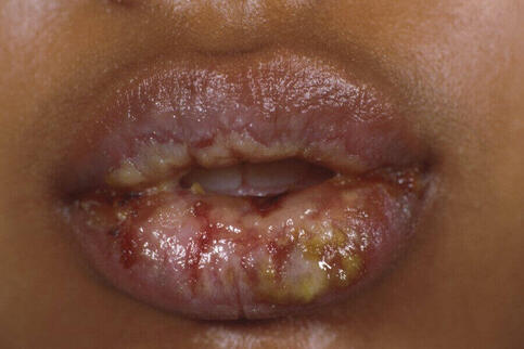 Choroba toksyczna nekroliza naskórka 