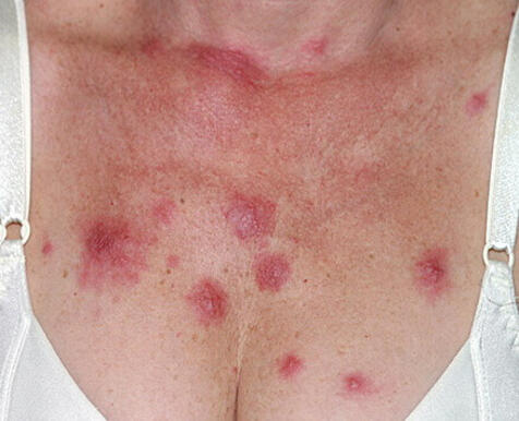 Choroba zespół Sweeta