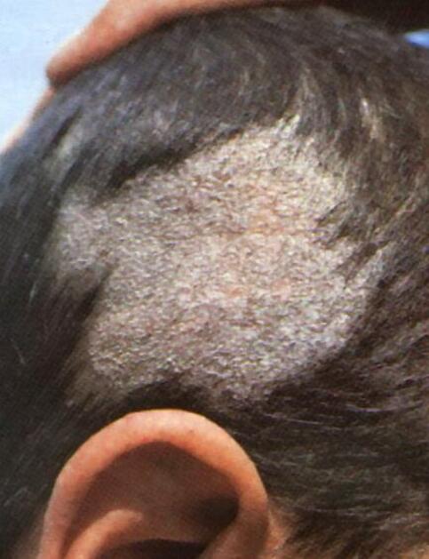 Choroby skóry głowy u dzieci grzybica
