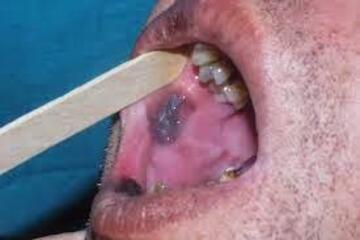 Czerniak błony śluzowej jamy ustnej