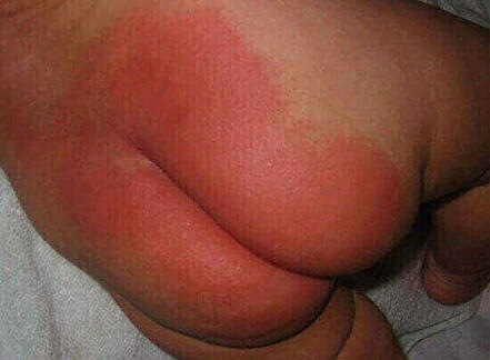 Czerwona pupa u niemowlaka 