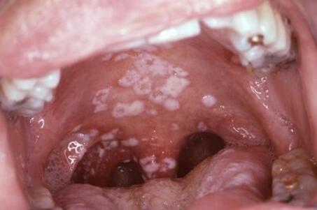 Grzybica jamy ustnej po antybiotyku