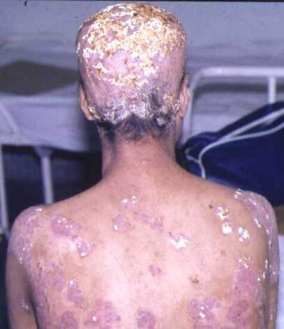 Grzybica parch, strupień woszczynowy 