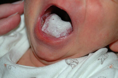 Grzybica w jamie ustnej dziecka