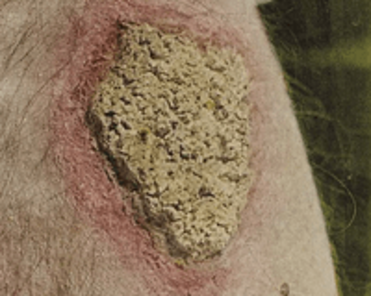 Grzybica woszczynowa skóry