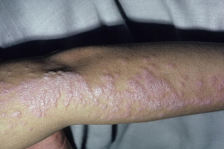 Jak wygląda liszaj płaski zdjęcie