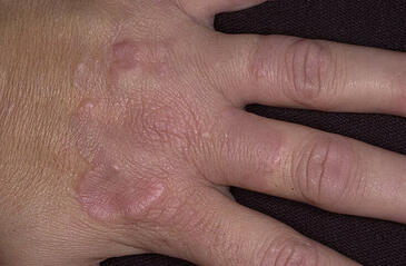 Jak wygląda ziarniniak obrączkowaty 