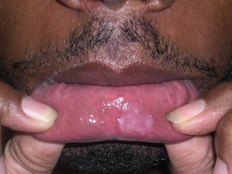 Kiła objawy na ustach