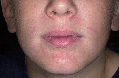 Krostki wokół ust u dziecka