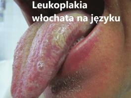 Leukoplakia włochata języka zdjęcia