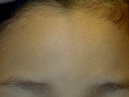 Liszaj lśniący na czole