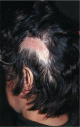 Liszaj płaski owłosionej skóry głowy 