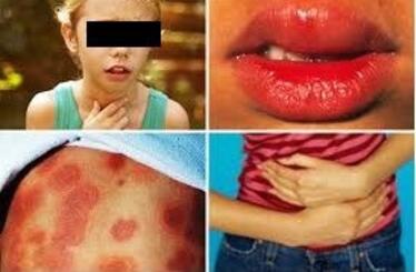 Objawy wstrząsu anafilaktycznego zdjęcia