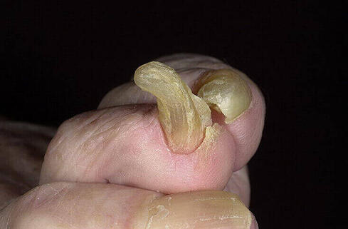 Onychogryfoza zdjęcie