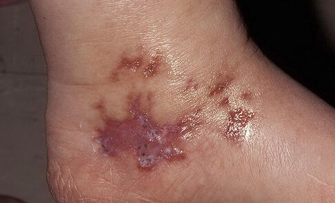 Piodermia zgorzelinowa 