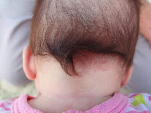 Pocałunek anioła znamię z tyłu głowy 