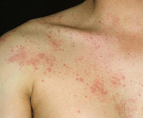 Pokrzywka cholinergiczna zdjęcie