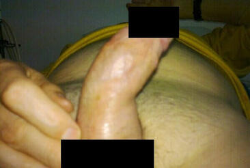 Prącie skrzywione w bok