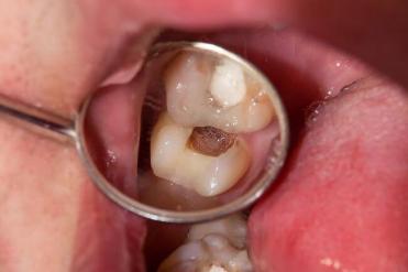 Przewlekłe włókniste zapalenie miazgi