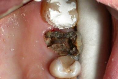 Przewlekłe zgorzelinowe zapalenie miazgi