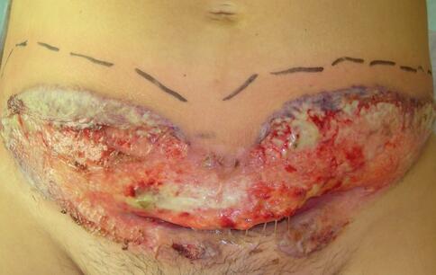 Rana po cesarskim cięciu wyciek piodermia zgorzelinowa