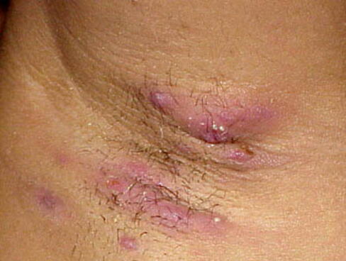 Ropne zapalenie apokrynowych gruczołów potowych zdjęcie