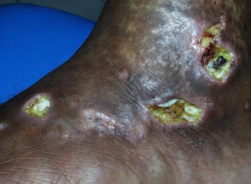 Ropne zgorzelinowe zapalenie skóry