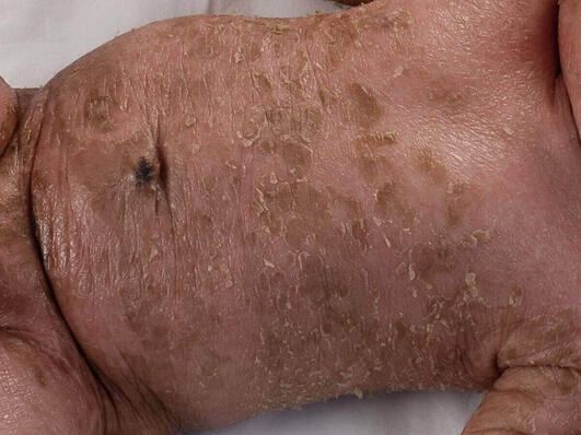 Rybia łuska blaszkowata 