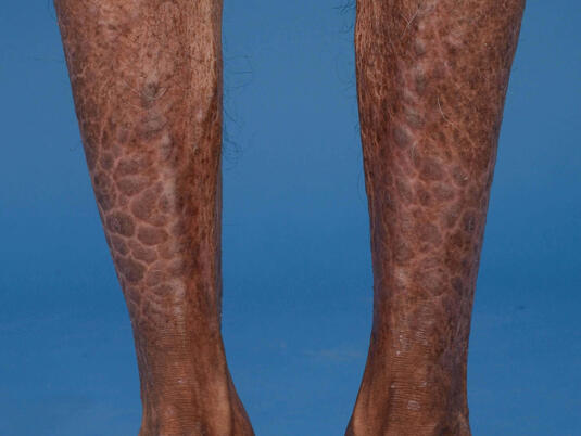 Rybia łuska sprzężona z chromosomem X