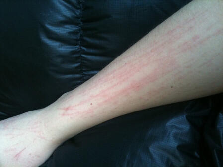 Swędzenie, drapanie rąk dłoni w czasie ciąży