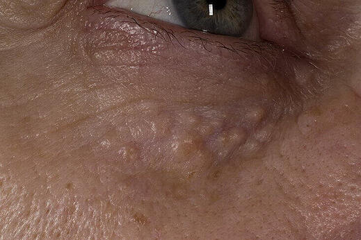 Syringoma, gruczolak potowy pod oczami