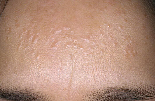 Syringoma, gruczolaki potowe 