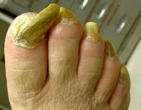 Szponowatość paznokci zdjęcie