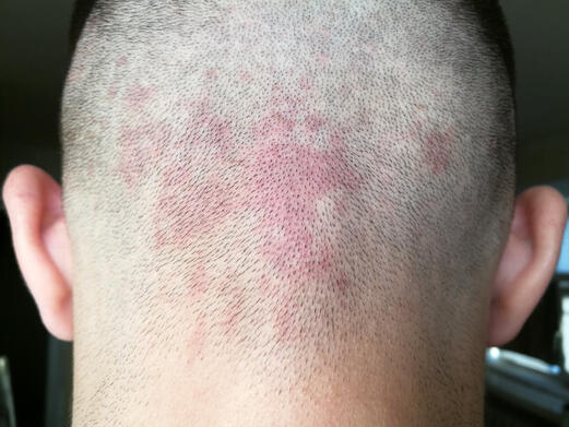 Uszczypnięcie bociana u dorosłych