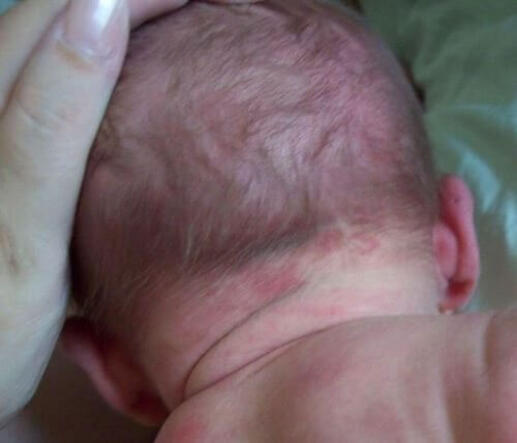 Uszczypnięcie bociana zdjęcia