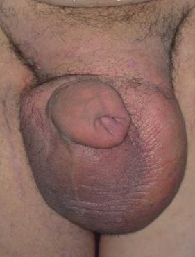 Wodniak jądra zdjęcia