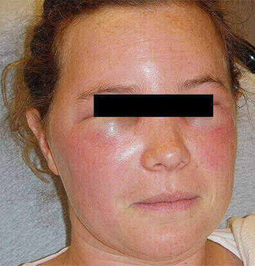 Wstrząs anafilaktyczny po ukąszeniu