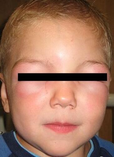 Wstrząs anafilaktyczny u dziecka