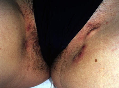 Zapalenie gruczołów apokrynowych pachwiny