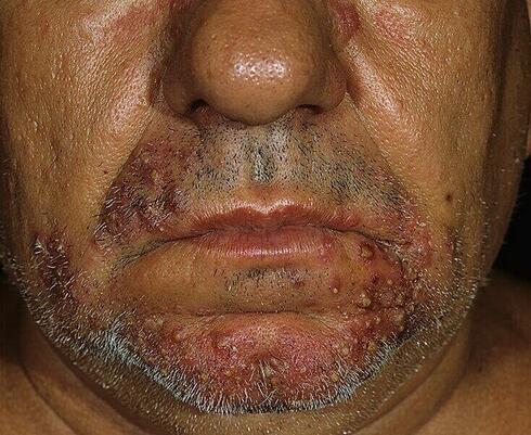 Zapalenie mieszków włosowych figówka