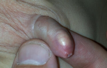 Zapalenie napletka u dziecka