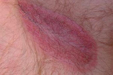 Zapalenie skóry w okolicy odbytu