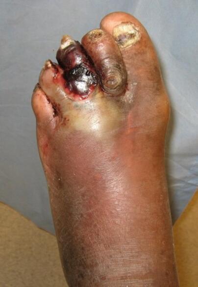 Zgorzel gazowa gangrena