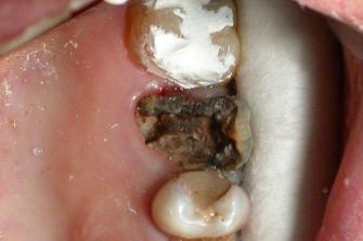 Zgorzelinowe zapalenie miazgi