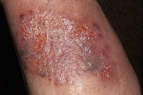 Zgorzelinowe zapalenie skóry 