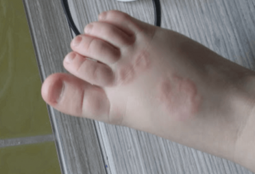 Ziarniniak obrączkowaty u dziecka