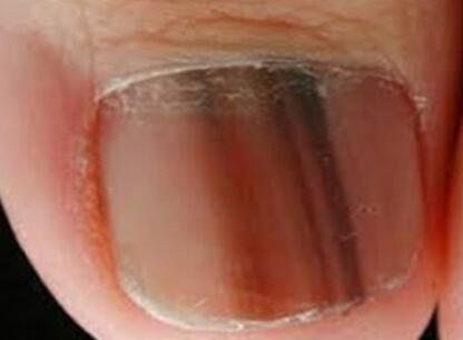 Zmiana koloru płytka paznokcia czerniak