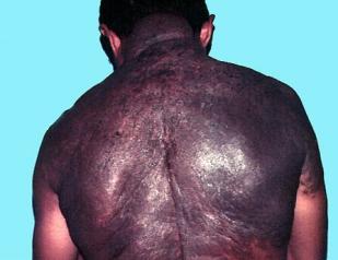 Znamię barwnikowe olbrzymie 