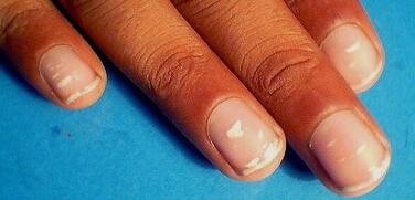 białe plamki na paznokciach