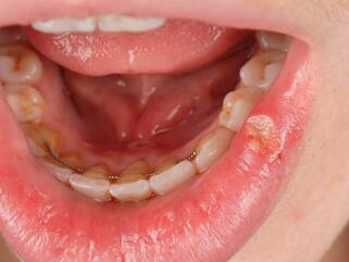 choroba behçeta zdjęcia